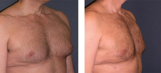 SlimLipo před a po prsa muži